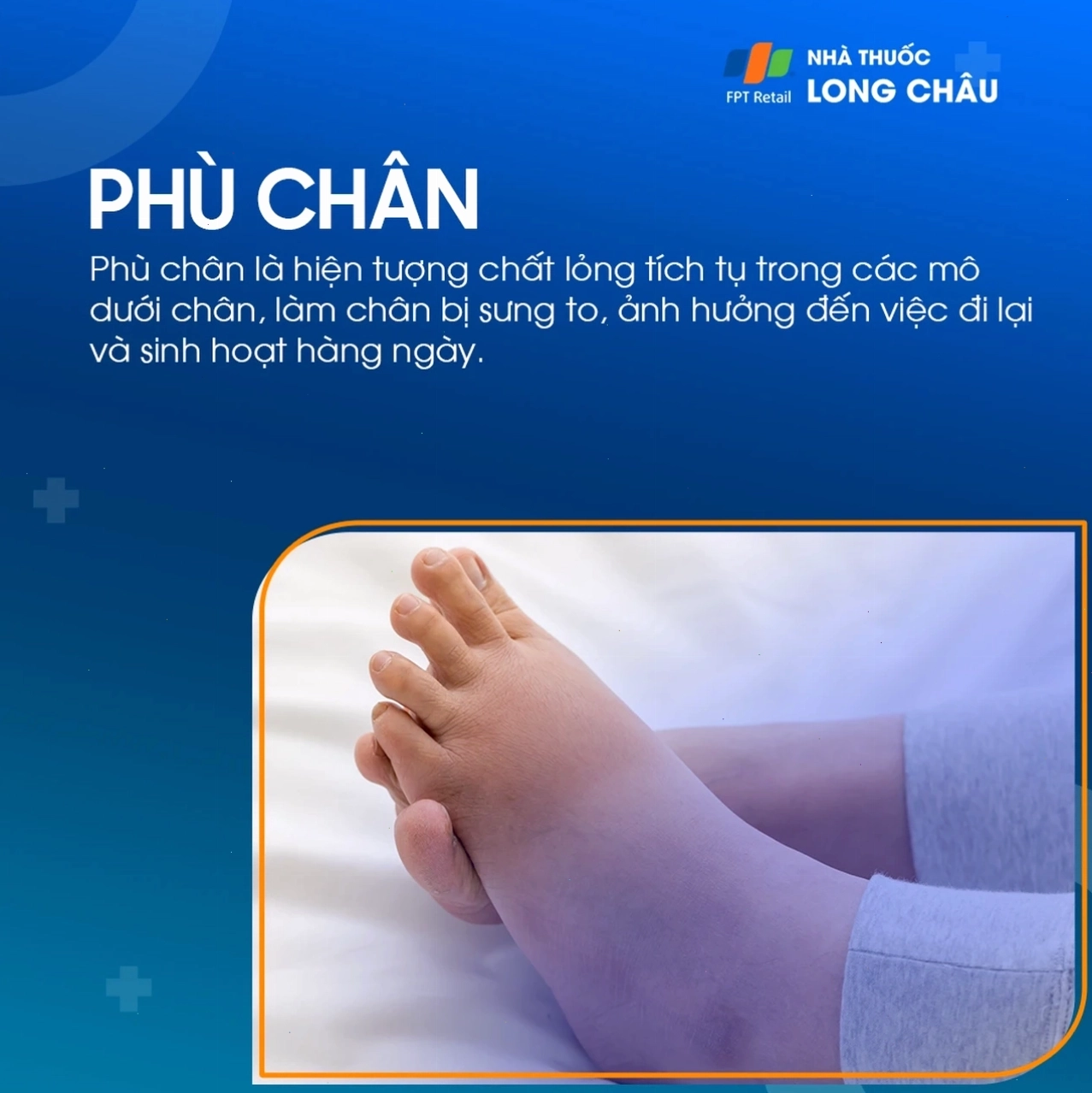 Phù chân giai đoạn đầu