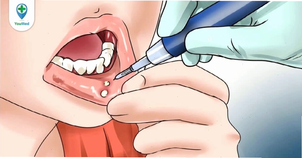 Phương pháp vệ sinh và chăm sóc miệng tại nhà giúp cải thiện sức khỏe niêm mạc