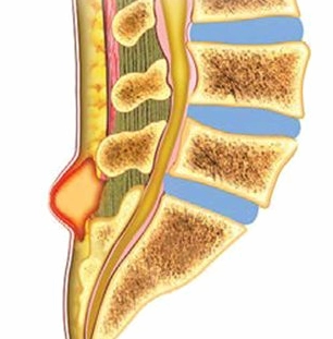 Pilonidal cyst là bệnh gì và những dấu hiệu nhận biết quan trọng