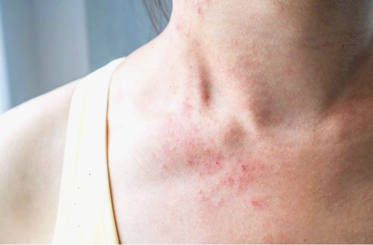 Quả sung đặc biệt có lợi cho người bị viêm da dị ứng