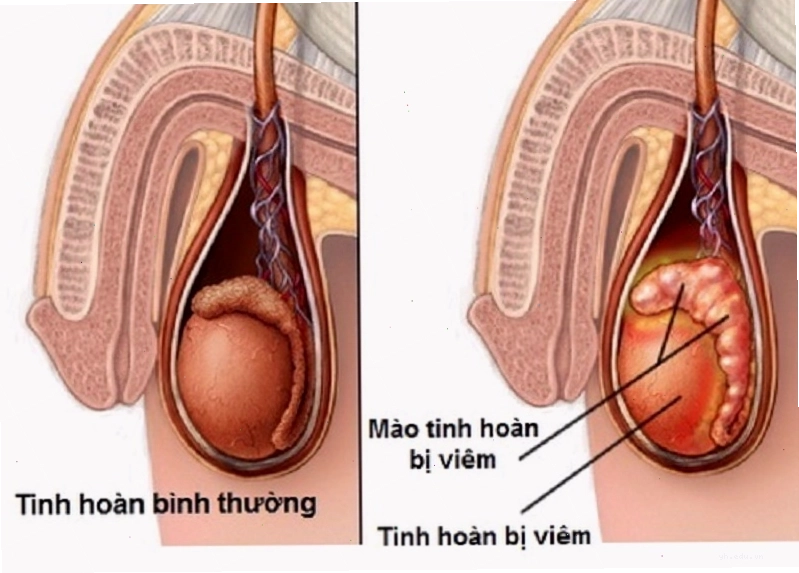 Quai bị có thể biến chứng gây viêm tinh hoàn