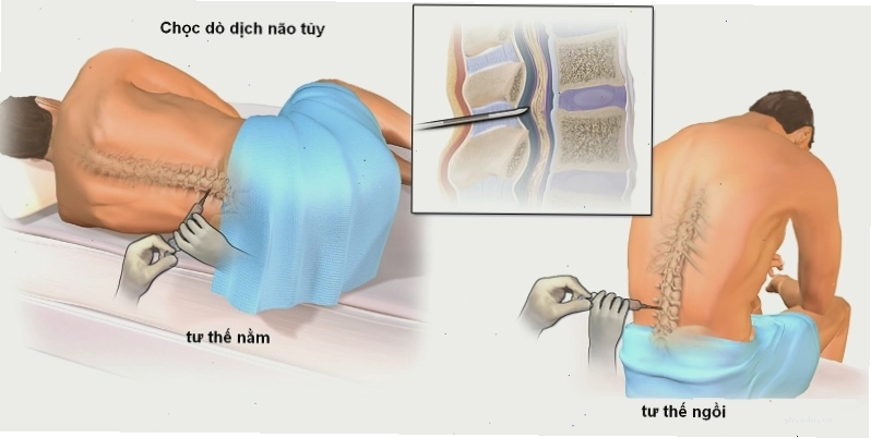 Quy trình chọc dò dịch não tủy