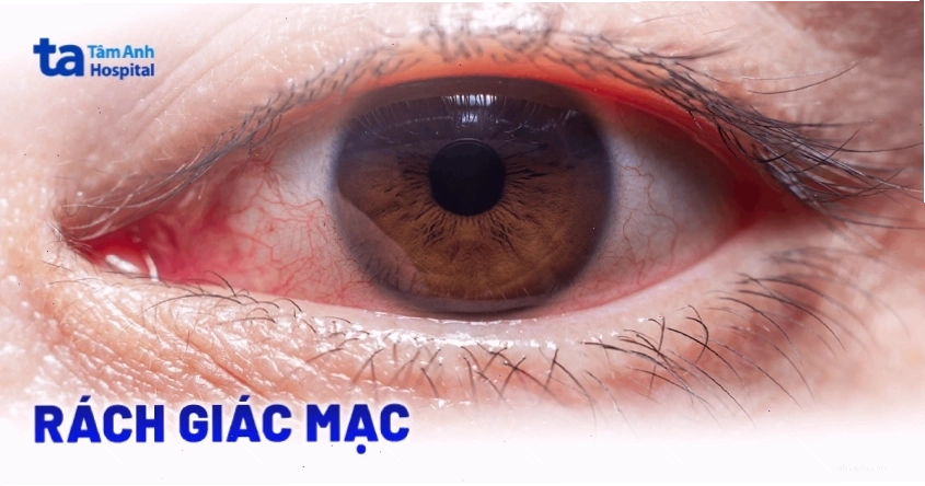 Rách giác mạc