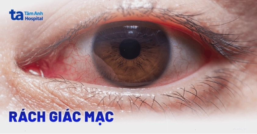 Rách giác mạc
