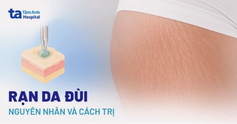 Rạn da đùi là tình trạng thường gặp cần chế độ chăm sóc riêng biệt