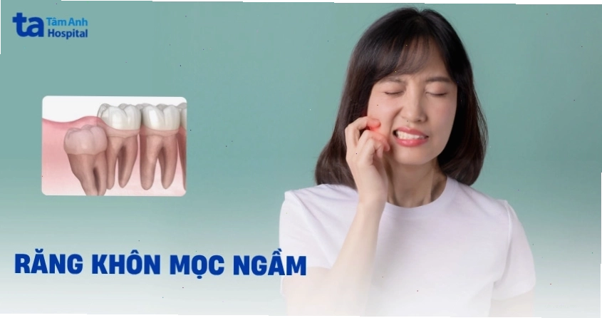 Răng khôn mọc ngầm