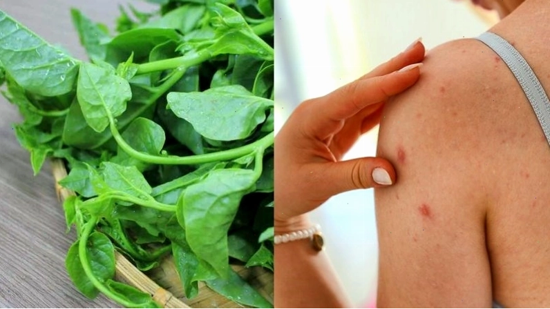 Rau mồng tơi giúp trị mụn nhọt