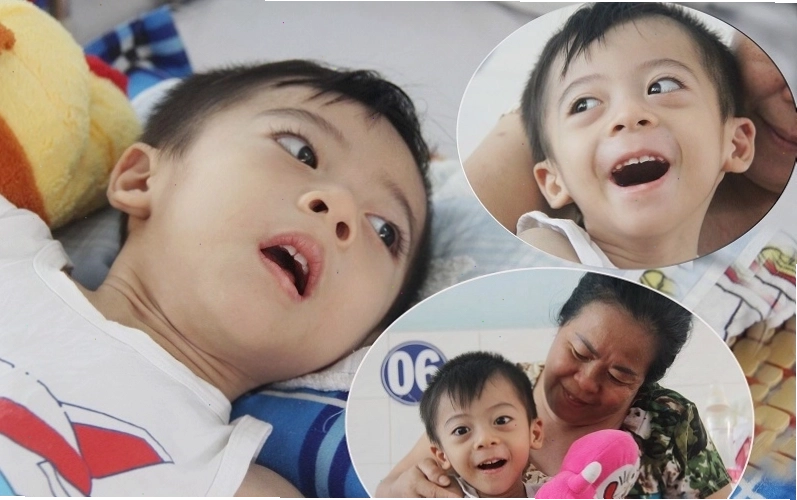 Rối loạn tâm thần ở trẻ bại não