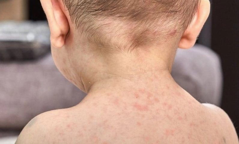 Roseola là bệnh gì và những điều cần biết để bảo vệ sức khỏe trẻ nhỏ
