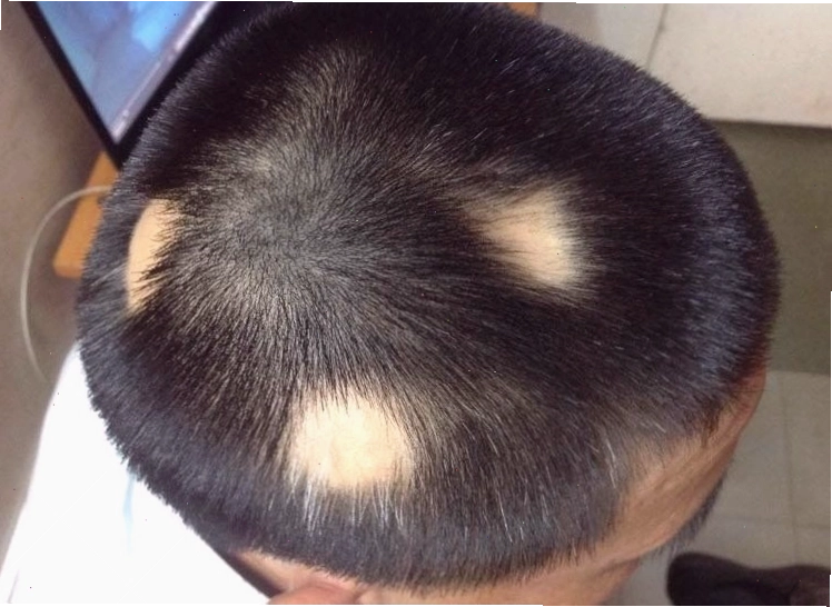 Rụng tóc phổ biến
