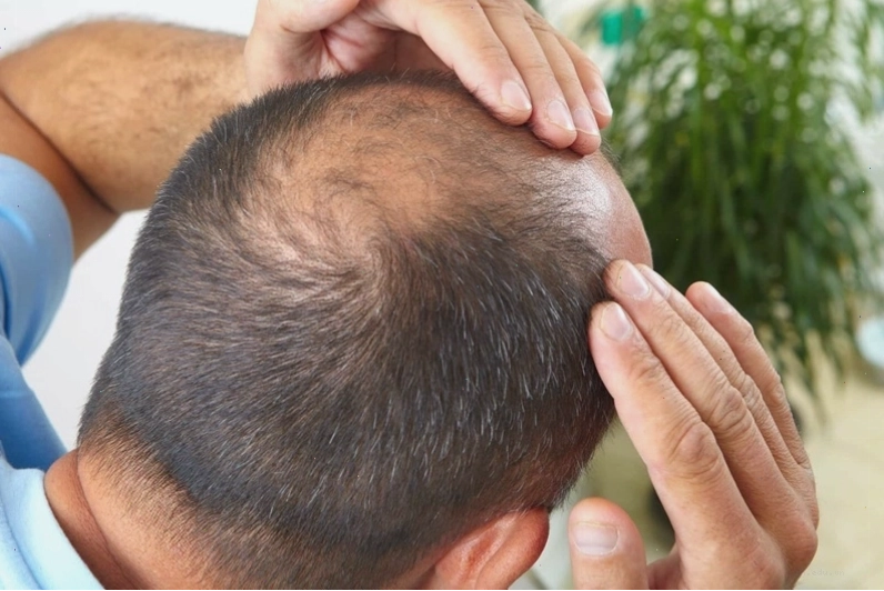 Rụng tóc quá nhiều dẫn đến hói đầu ở nam giới