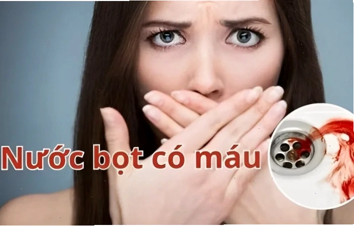 Sáng ngủ dậy thấy nước bọt có máu
