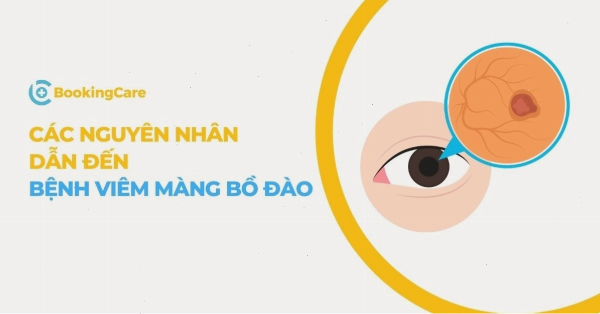 Sơ đồ các nguyên nhân gây bệnh viêm màng bồ đào thường gặp