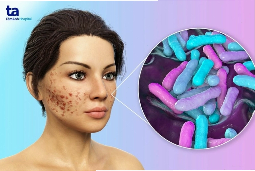 Sơ đồ các nguyên nhân gây mụn phổ biến từ nội tiết đến môi trường