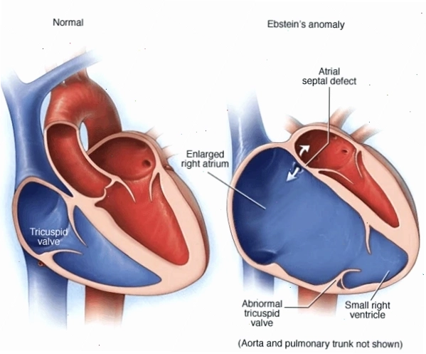 Sơ đồ cấu trúc van ba lá nằm thấp hơn bình thường trong bệnh Ebstein