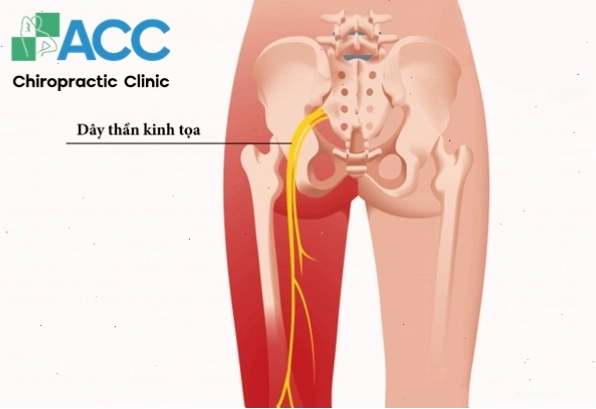 Sơ đồ giải thích cơ chế tê chân