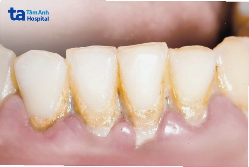Sơ đồ mô phỏng nguyên nhân gây bệnh nha chu