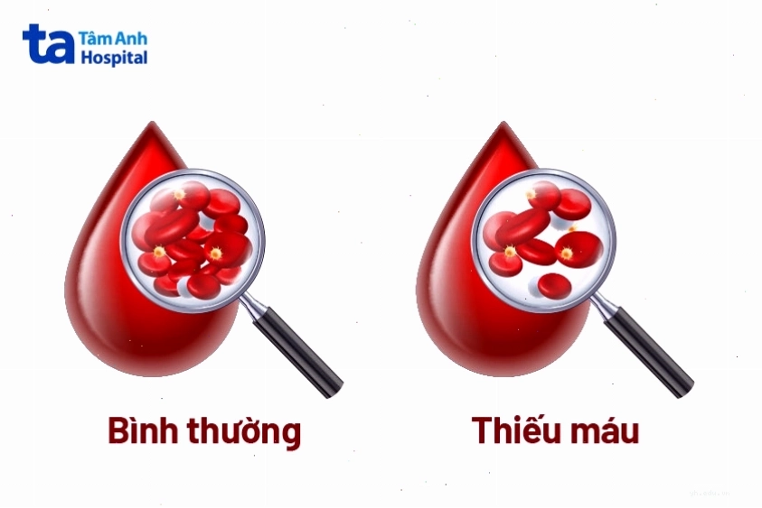Số lượng hồng cầu hoặc nồng độ huyết sắc tố trong hồng cầu thấp khi mắc bệnh
