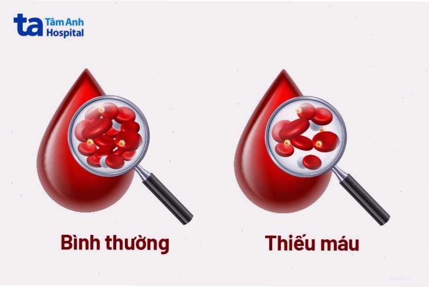 Số lượng hồng cầu thấp trong máu