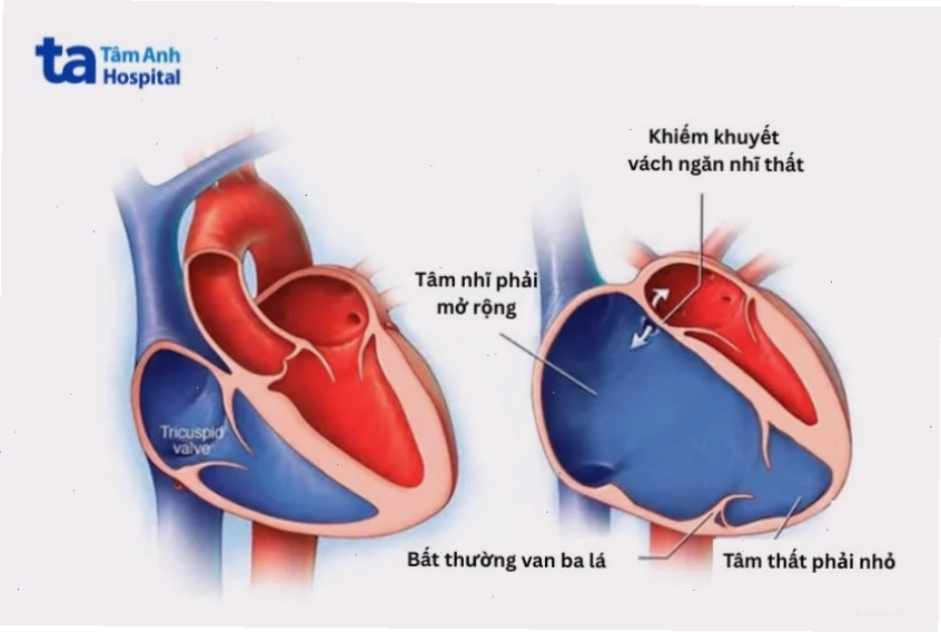 So sánh cấu trúc trái tim bình thường và trái tim mắc dị tật Ebstein