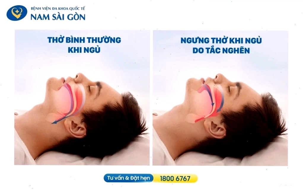 So sánh đường thở bình thường và đường thở bị tắc nghẽn