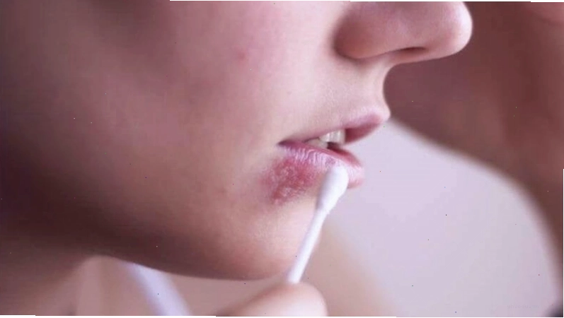 Sử dụng thuốc bôi chuyên dụng hỗ trợ điều trị chốc mép