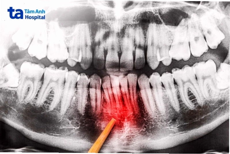 Sự khác biệt giữa tình trạng viêm nướu và viêm nha chu tiến triển