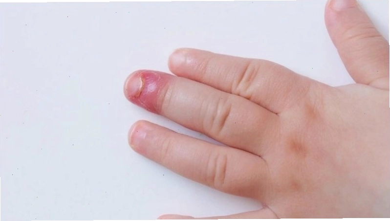 Sưng đỏ, phù nề đầu ngón tay là triệu chứng chính của bệnh chín mé