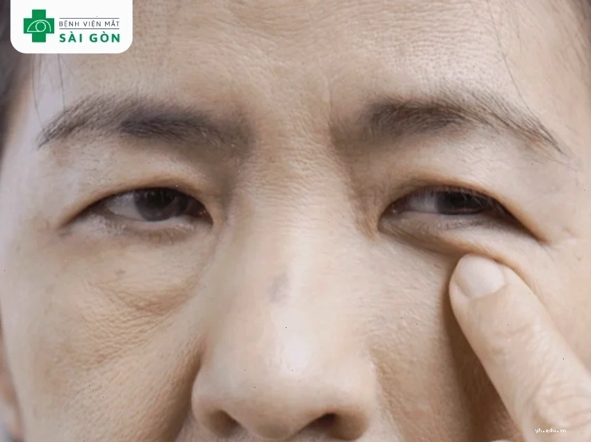 Sụp mí gây cản trở tầm nhìn