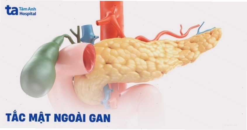 Tắc mật ngoài gan