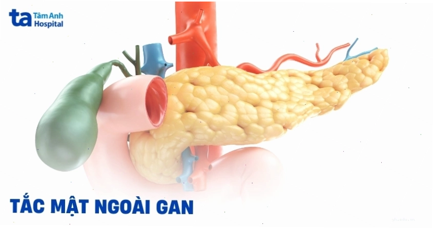 Tắc mật ngoài gan dấu hiệu nhận biết