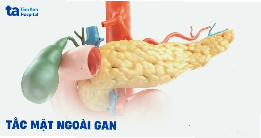 Tắc mật ngoài gan