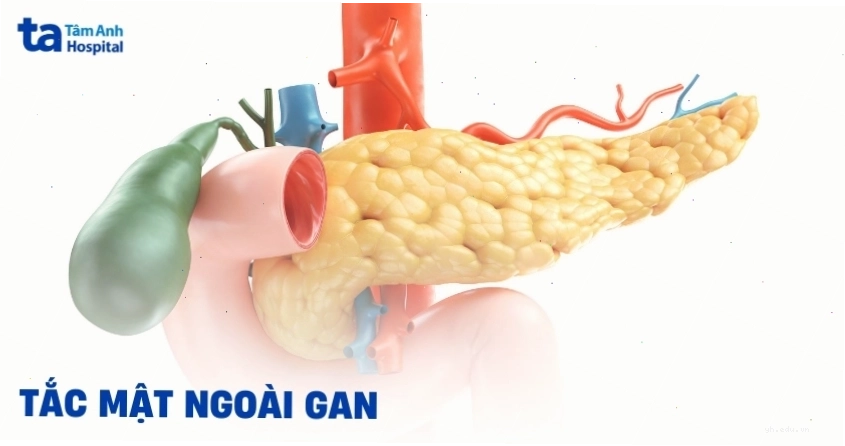 Tắc mật ngoài gan là một biến chứng nguy hiểm cần lưu ý