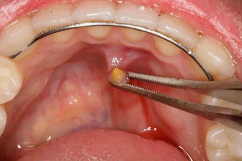 Tăng tiết nước bọt bất thường có thể do bệnh lý tuyến nước bọt