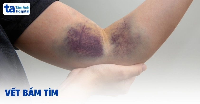 Tay chân hay bị bầm tím là bệnh gì và khi nào cần đi khám
