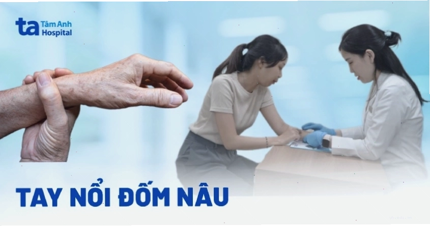 Tay nổi đốm nâu nguyên nhân vì sao? Dấu hiệu và cách phòng ngừa