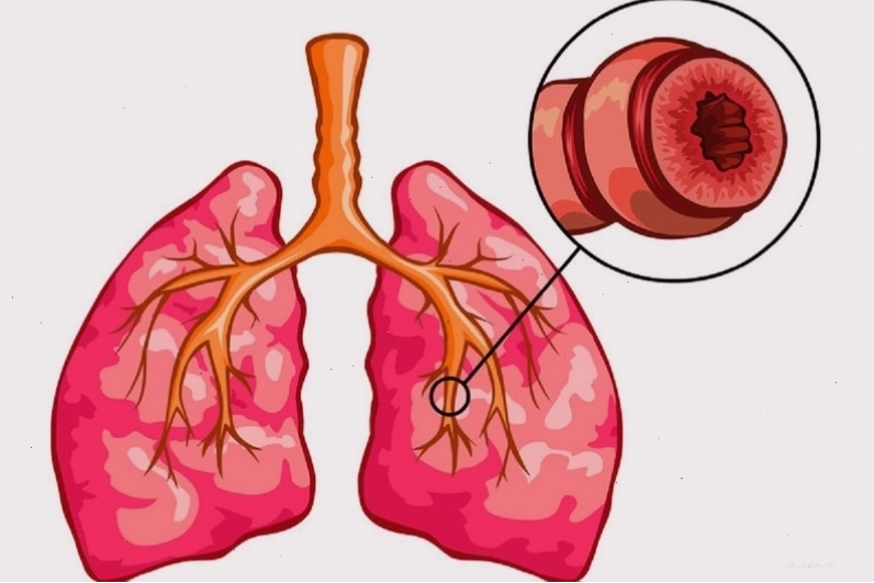 Tế bào phổi bị viêm nhiễm dưới kính hiển vi