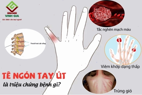 Tê hai ngón tay út và áp út