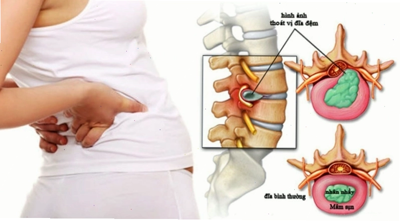 Tê tay do thoát vị đĩa đệm