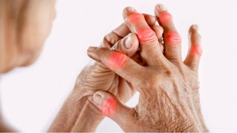 Thấp khớp giai đoạn sưng