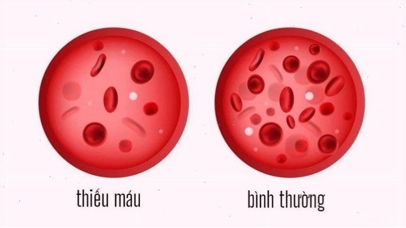 Thiếu máu làm giảm oxy lên não bộ gây ra choáng váng