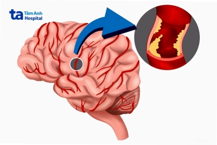 Thiếu máu não gây ảnh hưởng đến cảm giác ở chân