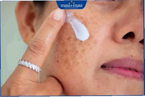 thoa kem trị nám