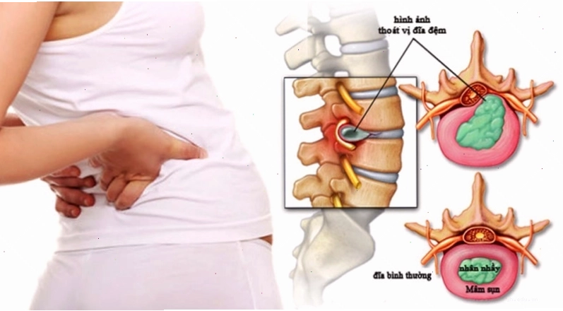 Thoát vị đĩa đệm cột sống cổ gây ra các cơn tê lan xuống bàn tay
