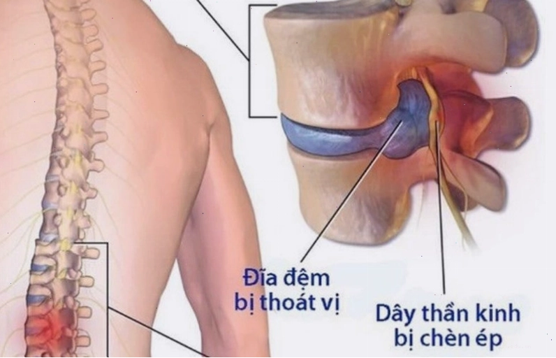 Thoát vị đĩa đệm gây tê bì chân tay