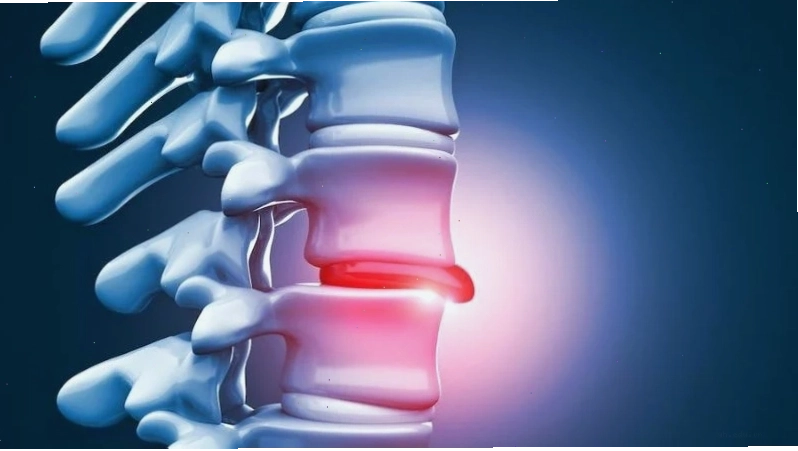 Thoát vị đĩa đệm là tình trạng đệm mô giữa các xương trong cột sống bị lệch