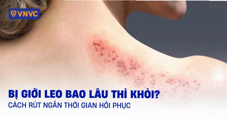 Thời gian hồi phục khi bị giời leo