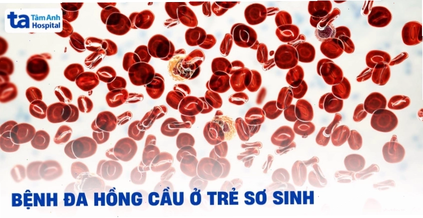 Thông tin cần biết về bệnh đa hồng cầu ở trẻ sơ sinh