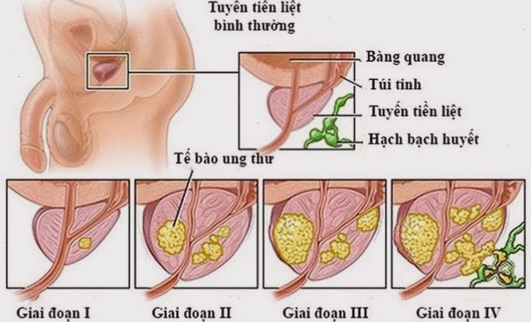 Thực phẩm dinh dưỡng hỗ trợ sức khỏe tuyến tiền liệt nam giới