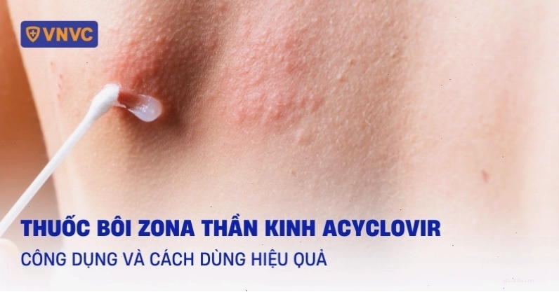 Thuốc bôi Zona thần kinh Acyclovir